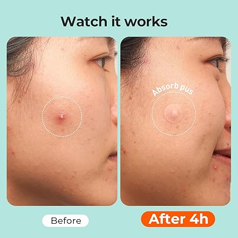 Hydrocolloid Pimple Patches 443 Count | 5 Sizes for Face & Body | Acne Patch for Whiteheads, Zits & Blemishes, All Skin Types